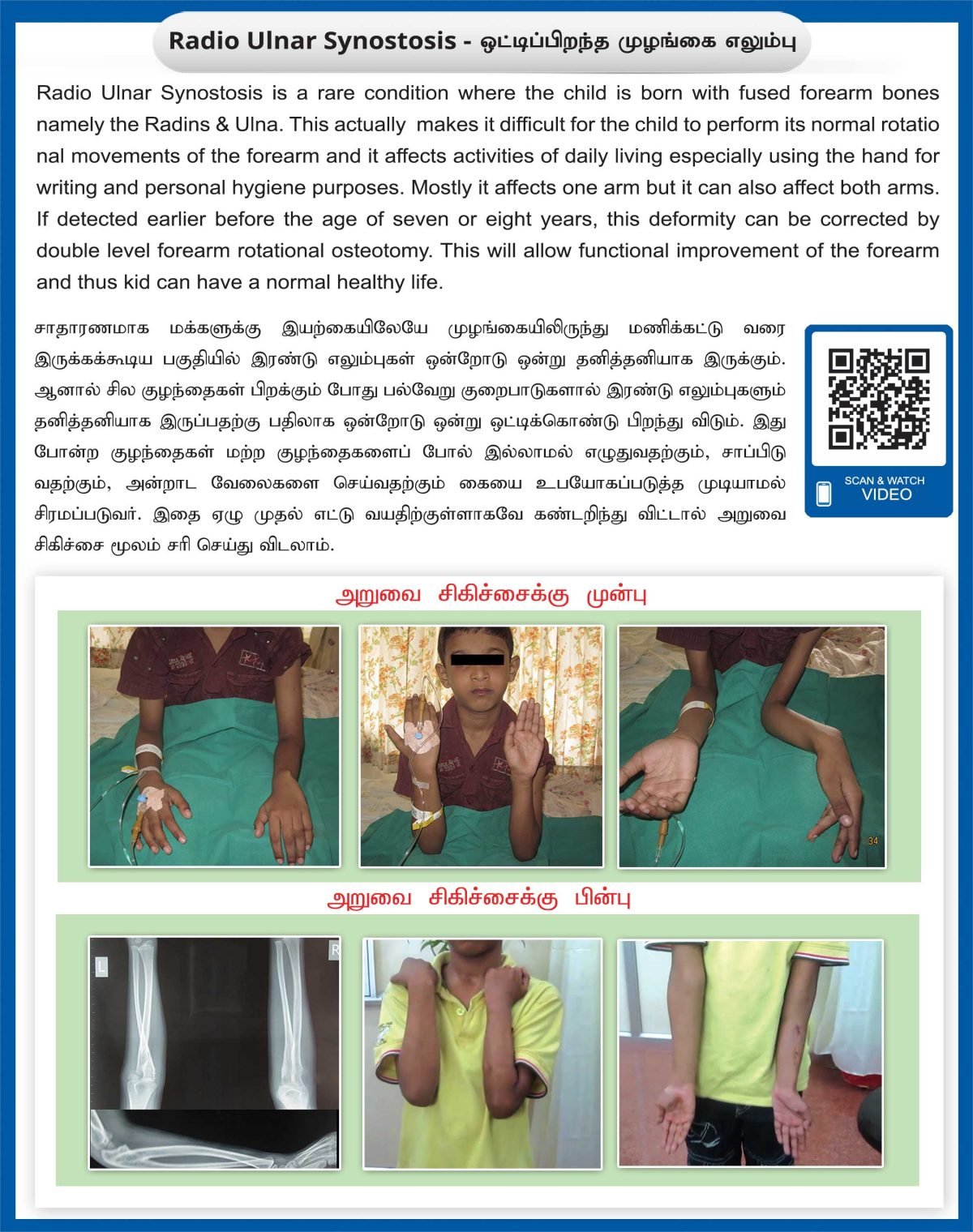 Radio Ulnar Synostosis